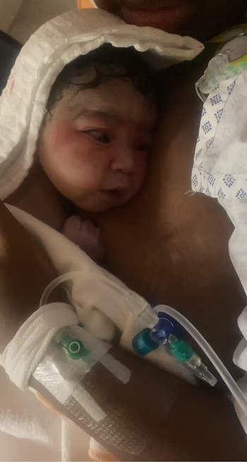 Epidural