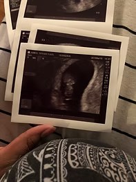 Missed Miscarriage